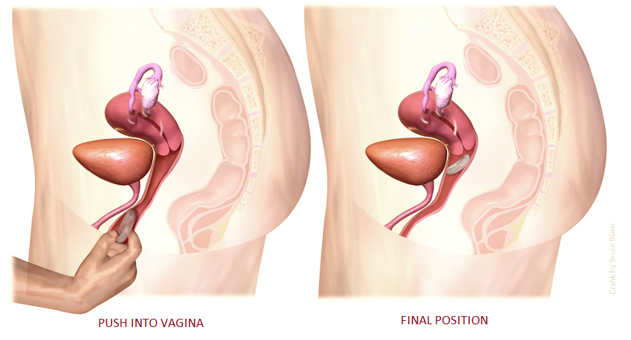 vaginalring